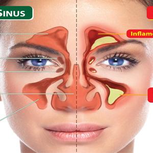 Asian Remedy For Sinus Infection - Fungal Sinusitis: 2 Guaranteed Medical Coding Formulas That Work