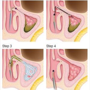  Know The Symptoms Of A Sinus An Infection In An Instant