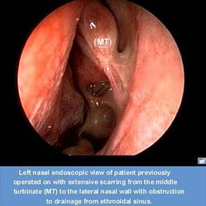  Spotlight On Sinusitis