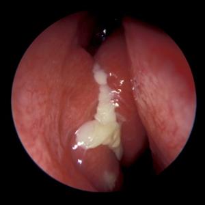 Sinus Drain - Things To Know About Sinusitis: Definition, Symptoms, Brings About, And Also Treatment