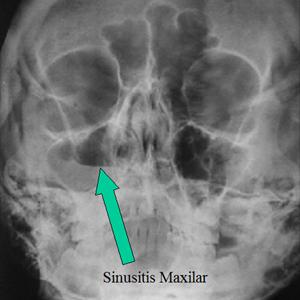 Causes Of Reocurring Sinus Infections 