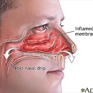 Sinusitis Cure - Sinus Infection And Sinusitis Eye Pain