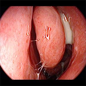 Symptoms Of Sinus Pressure - Say Bye To Sinusitis Along With Balloon Sinuplasty