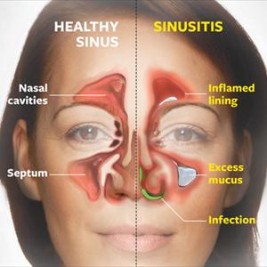 Sinus Congestion Remedies - Maxillary Sinusitis - Symptoms And Treatment