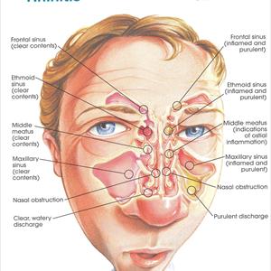 Home Remedies For Sinus Problems - Natural Treatment For Headaches Along With Other Aches