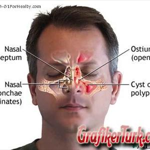 Sinusitis Symptoms 