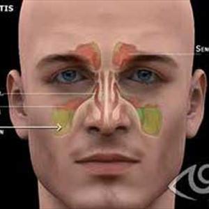 Chronic Sinusitis Lupus - Balloon Sinuplasty - A Breakthrough Procedure For Chronic Sinusitis Sufferers