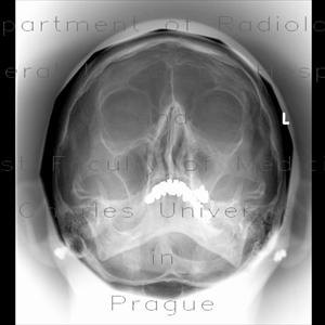 Untreated Sinus Infection And Dizziness 