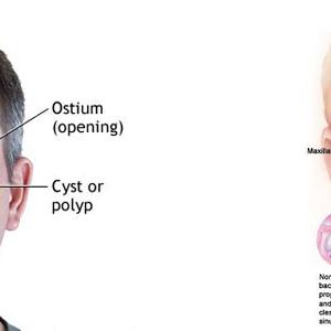 Chronic Sinusitis Herbal - Sinusitis Treatment Is An Easy Way To Get Rid Of Sinus