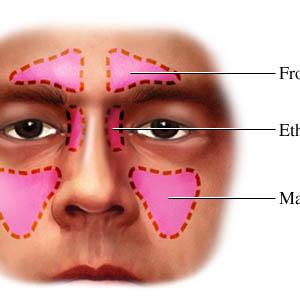 Pressure In Sinuses Dizziness - Treatment Options For Nasal Polyps