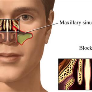 Remedies For Sinus Infection 