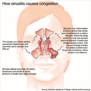 Chronic Sinusitis Herbal - Sinusitis Treatment Is An Easy Way To Get Rid Of Sinus