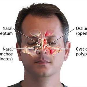 Symptoms Of Vertigo - Acute Sinusitis: What Are Your Remedy Options?