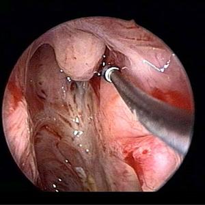 sinusitis intracranial headaches