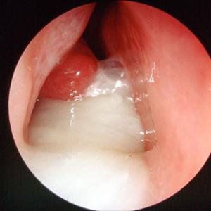 Natural Sinusitis Treatment 