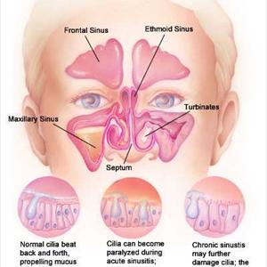 Antibiotics For Sinusitis - Treating Sinusitis And Nose Infections