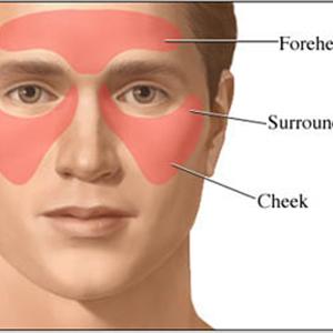 Impacted Sinus - How The Nose Affects Sinusitis