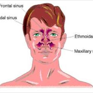 Sinuvil Buy - Information On A Sinus Fungal Infection