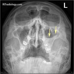 Sinus Pressure Cause Blurry Vision - When Chronic Sinusitis Attacks