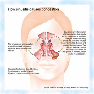 Home Remedies For Sinus Pressure - Management Of Nasal Polyps