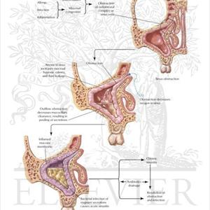 Blocked Sinus - Fungal Sinusitis Because Of The Need For Mold Treatment